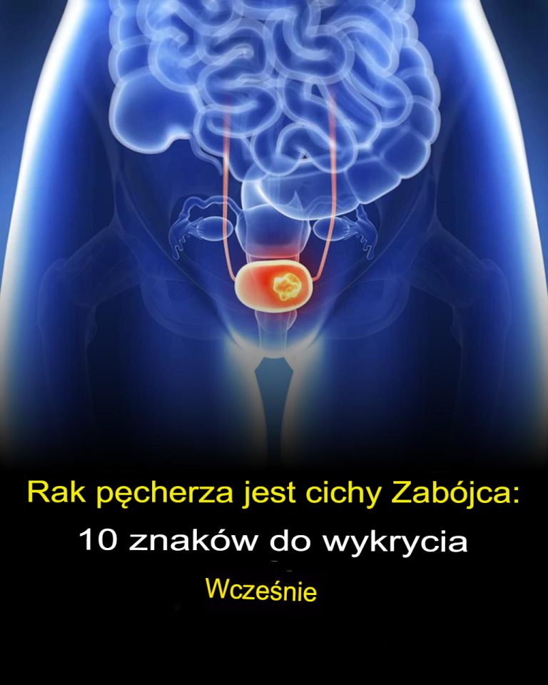 10 Objawów Raka Pęcherza Moczowego, Których Nie Można Ignorować!