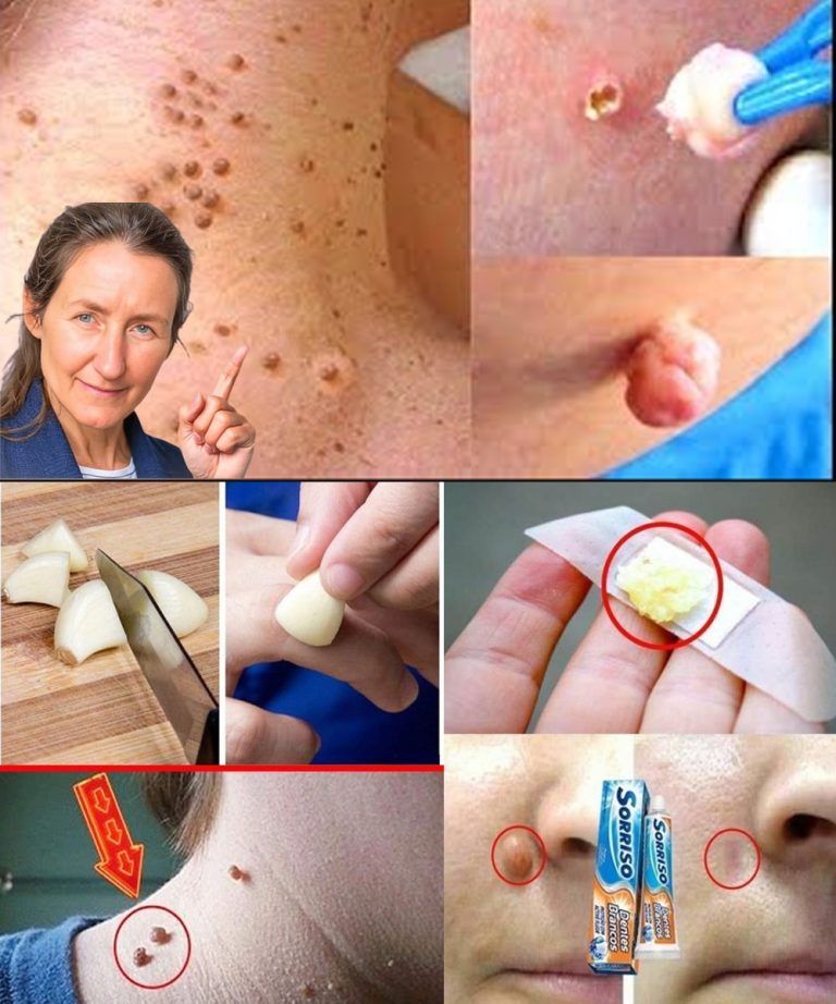 Brodawki podeszwowe i narośla skórne znikną naturalnie dzięki tej sztuczce