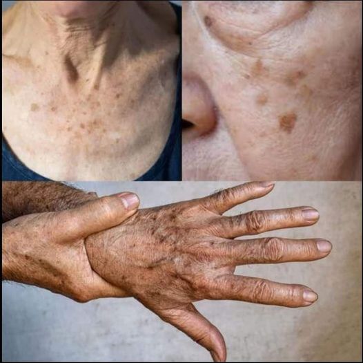 Odkryj moc selenu – niezbędnego pierwiastka zapobiegającego powstawaniu plam starczych