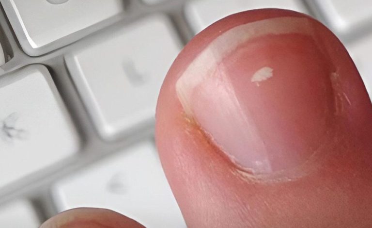 Dlaczego na paznokciach pojawiają się białe plamy?