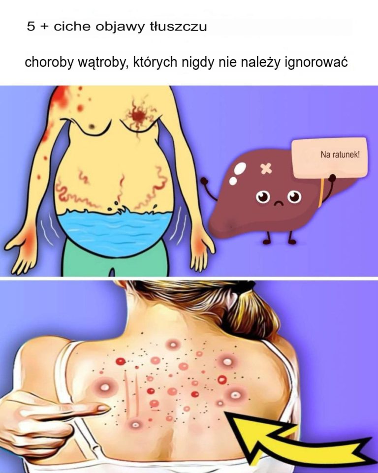 Stłuszczenie wątroby: przyczyny, objawy, leczenie i domowe sposoby
