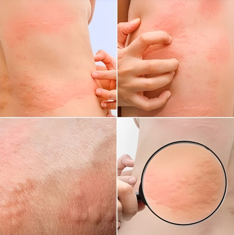 UWAGA! Jeśli zauważysz te kropki na skórze, oznacza to, że masz Ca…zobacz więcej