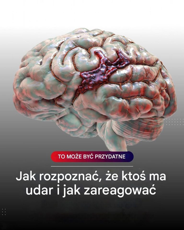 Jak rozpoznać udar? (udar mózgu)