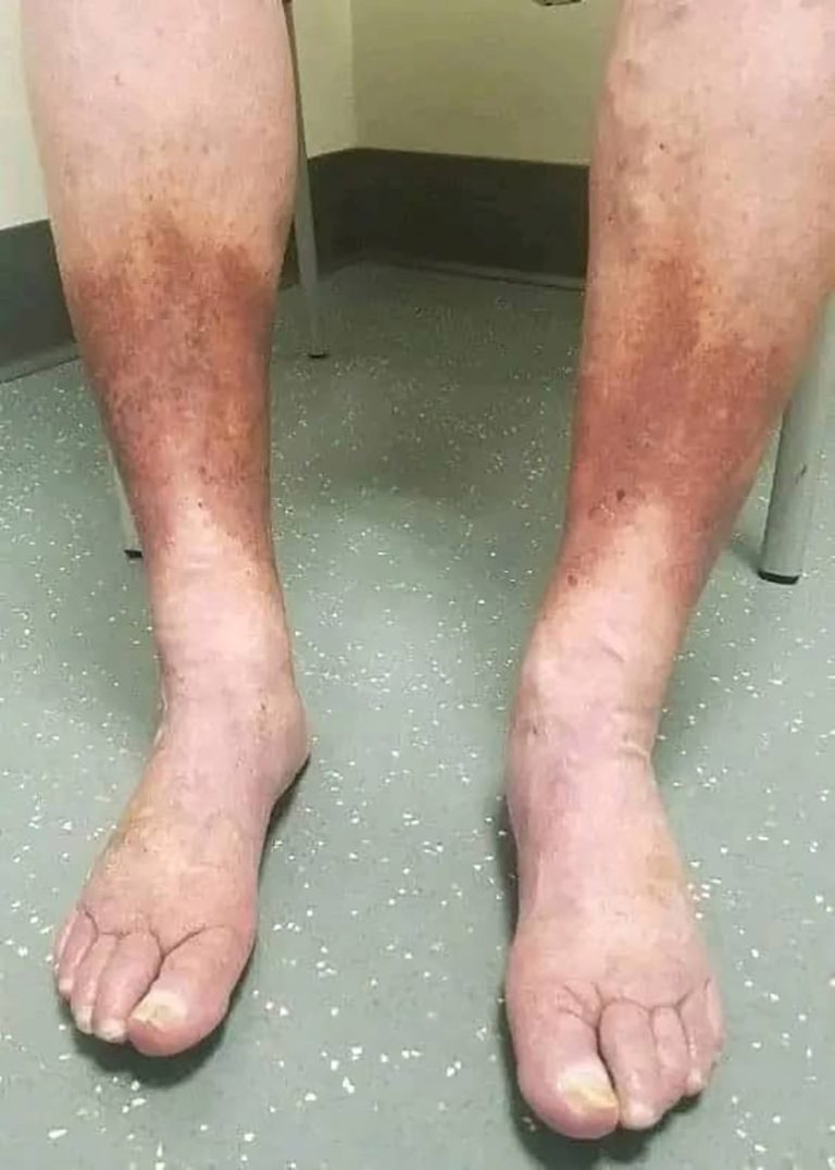 Jakie są pierwsze objawy choroby Lou Gehriga?