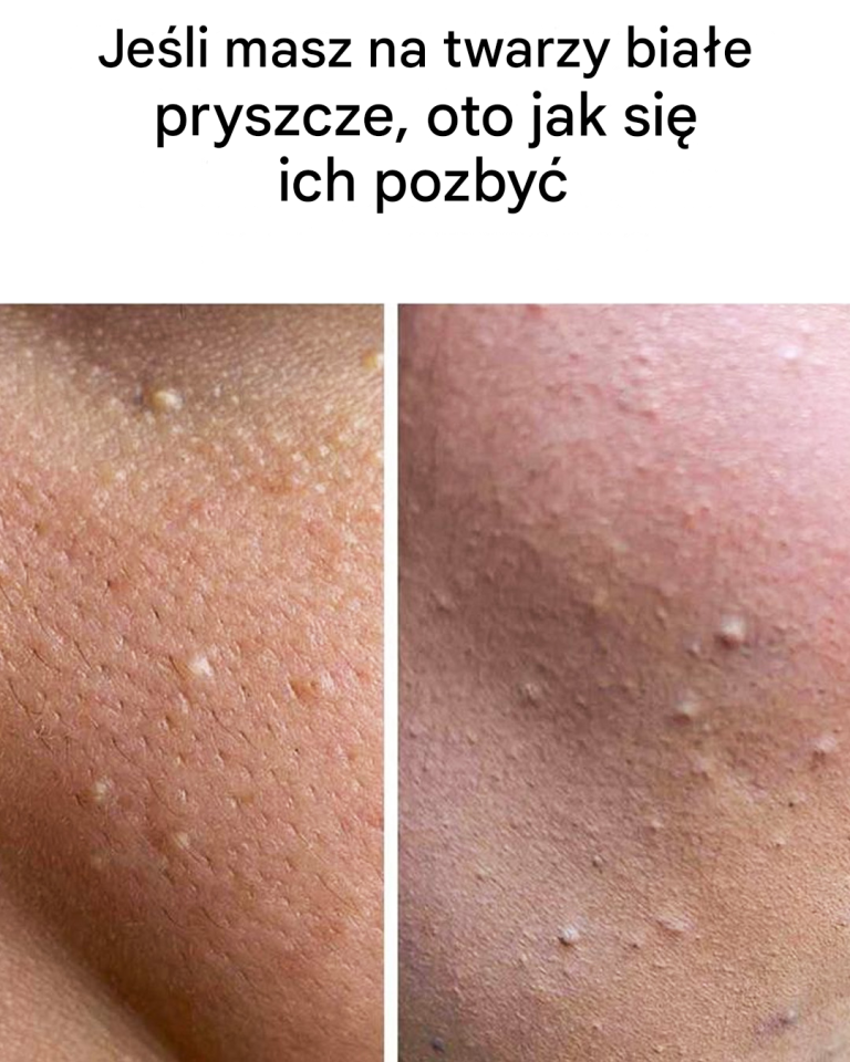Jeśli masz białe pryszcze na twarzy, oto co one oznaczają i jak się ich pozbyć