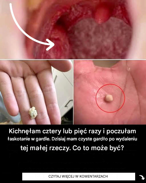 Kiedy i jak wykonuje się operację migdałków?