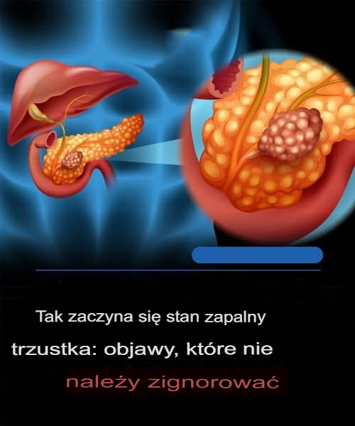 Objawy raka trzustki, które warto znać i jak rozwija się choroba