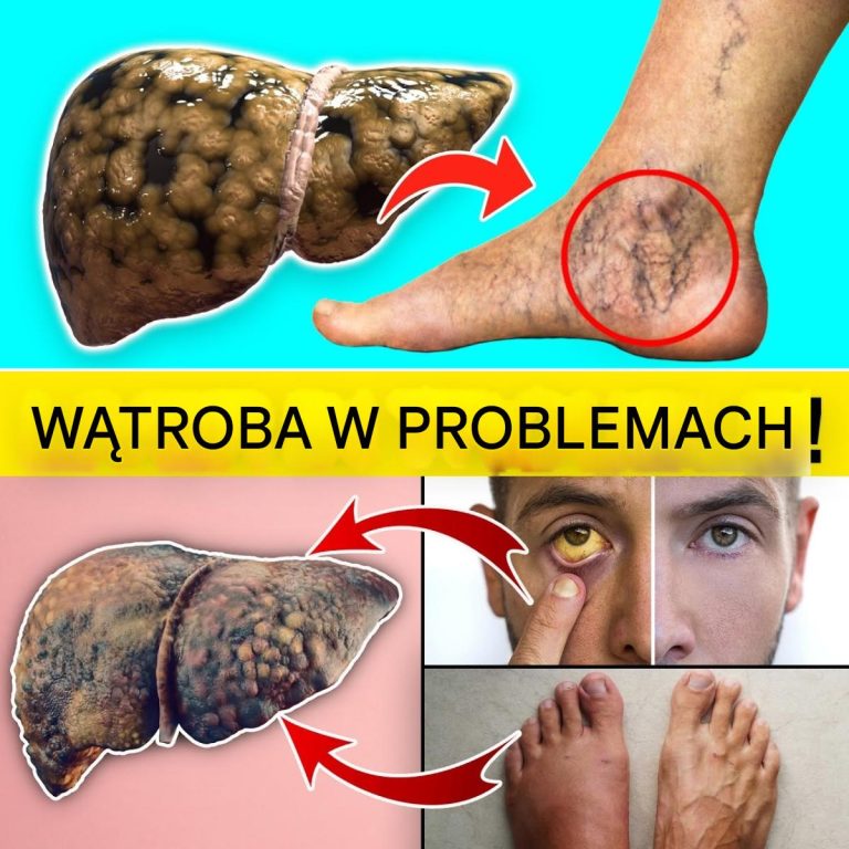 15 wczesnych ostrzegawczych znaków, że Twoja wątroba może mieć problemy