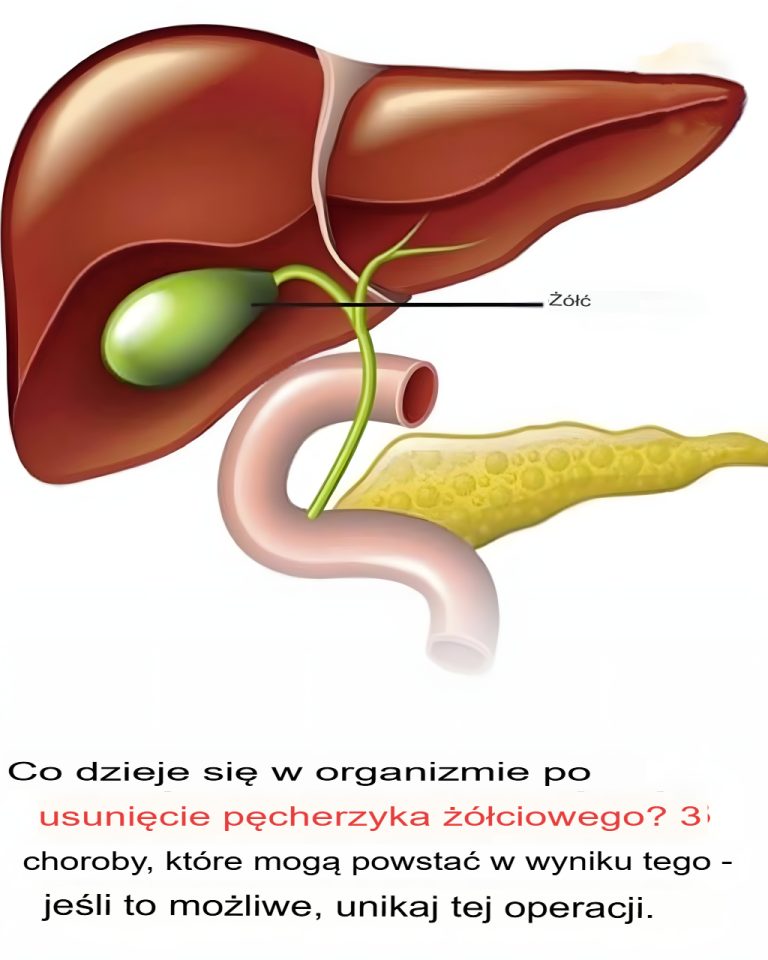 Co dzieje się w ciele po usunięciu pęcherzyka żółciowego? 3 choroby, które mogą wystąpić
