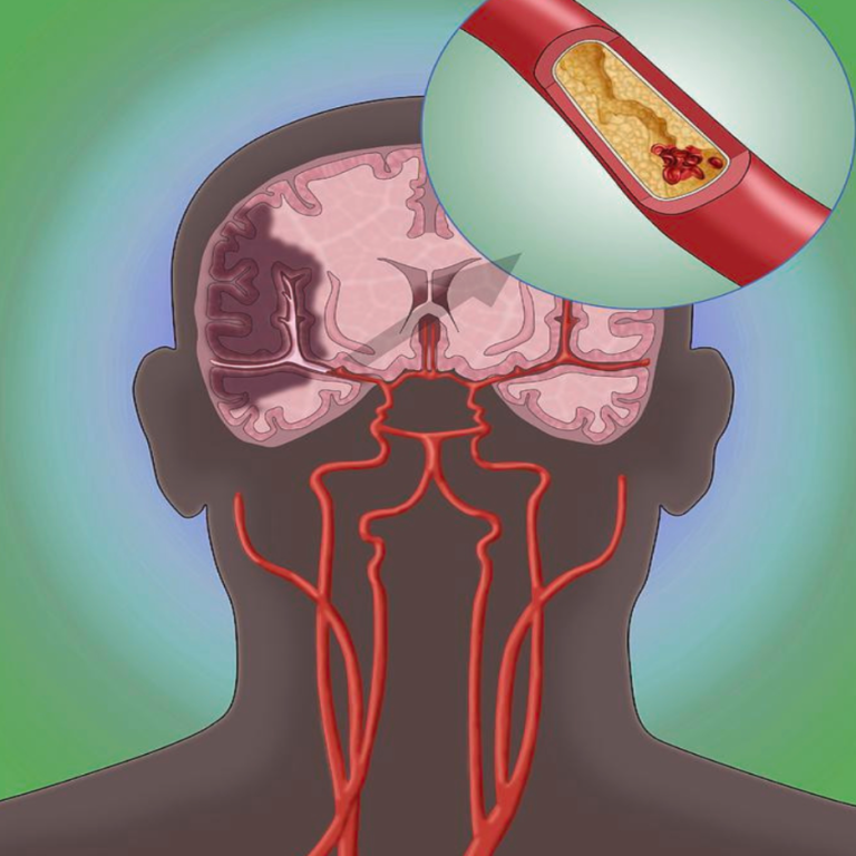 10 oznak zatkanych tętnic – sygnały, których nie wolno ignorować