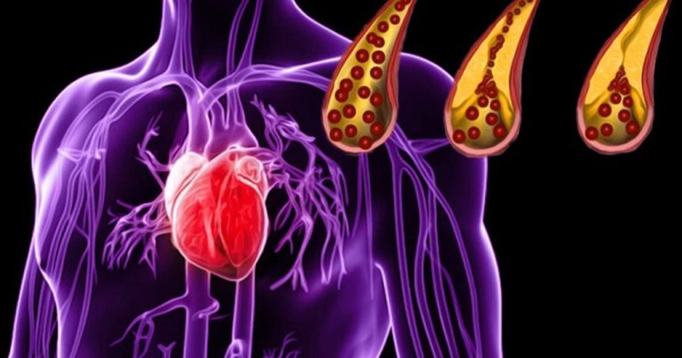 10 produktów spożywczych, które naturalnie oczyszczają tętnice i chronią przed zawałami serca