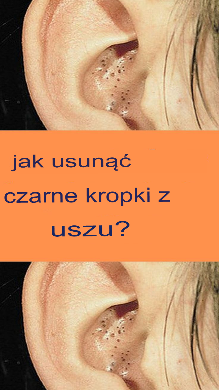 Jak usunąć zaskórniki z uszu?