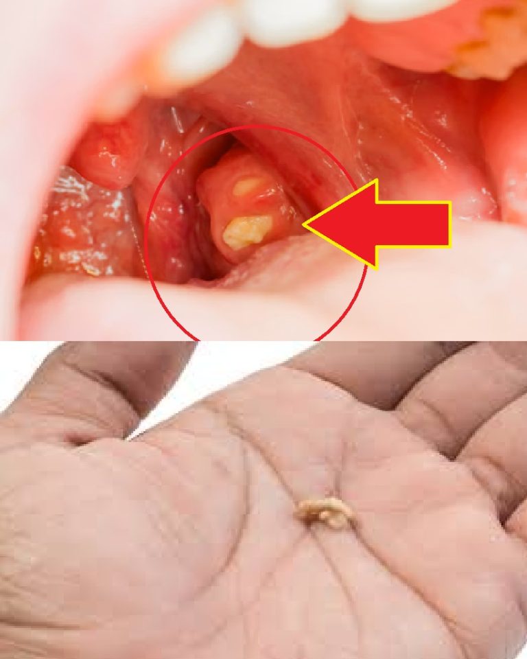 Jeśli masz białe grudki w gardle, oznacza to, że… zobacz więcej