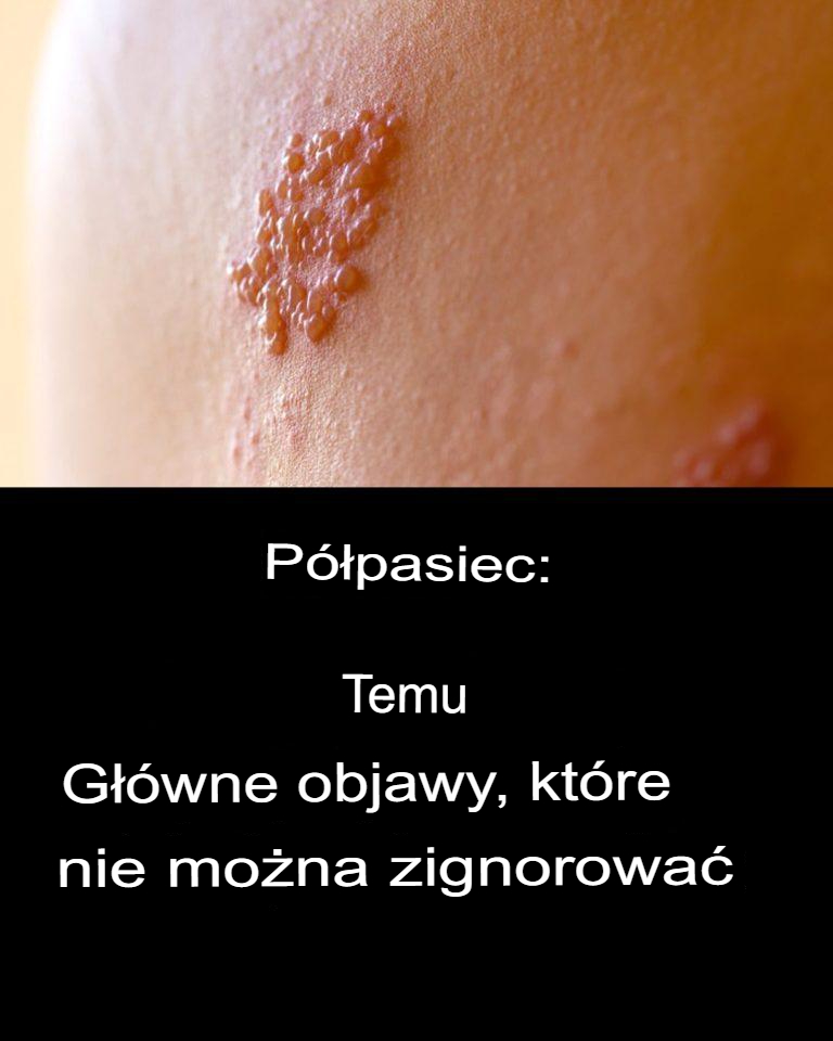 Półpasiec: objawy, powikłania i zapobieganie