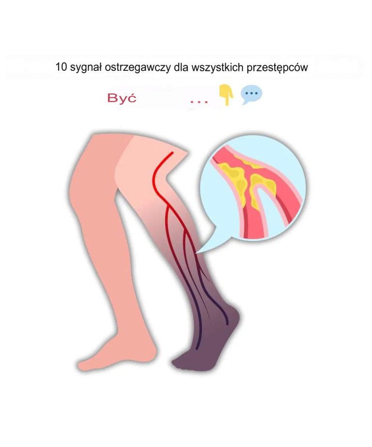 10 najczęstszych objawów zakrzepu krwi w nodze (zapobiegających zakrzepicy żył głębokich)