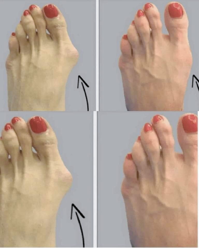 Jak naturalnie złagodzić haluksy (hallux valgus)?