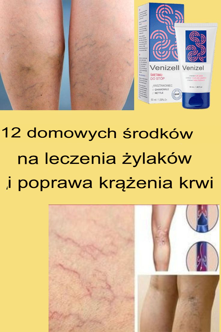 12 domowych sposobów na leczenie żylaków i poprawę krążenia