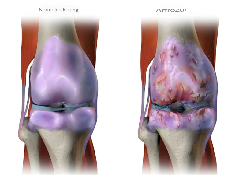Oto wszystko, co musisz wiedzieć o zdrowiu swoich stawów (i jak naturalnie je poprawić)