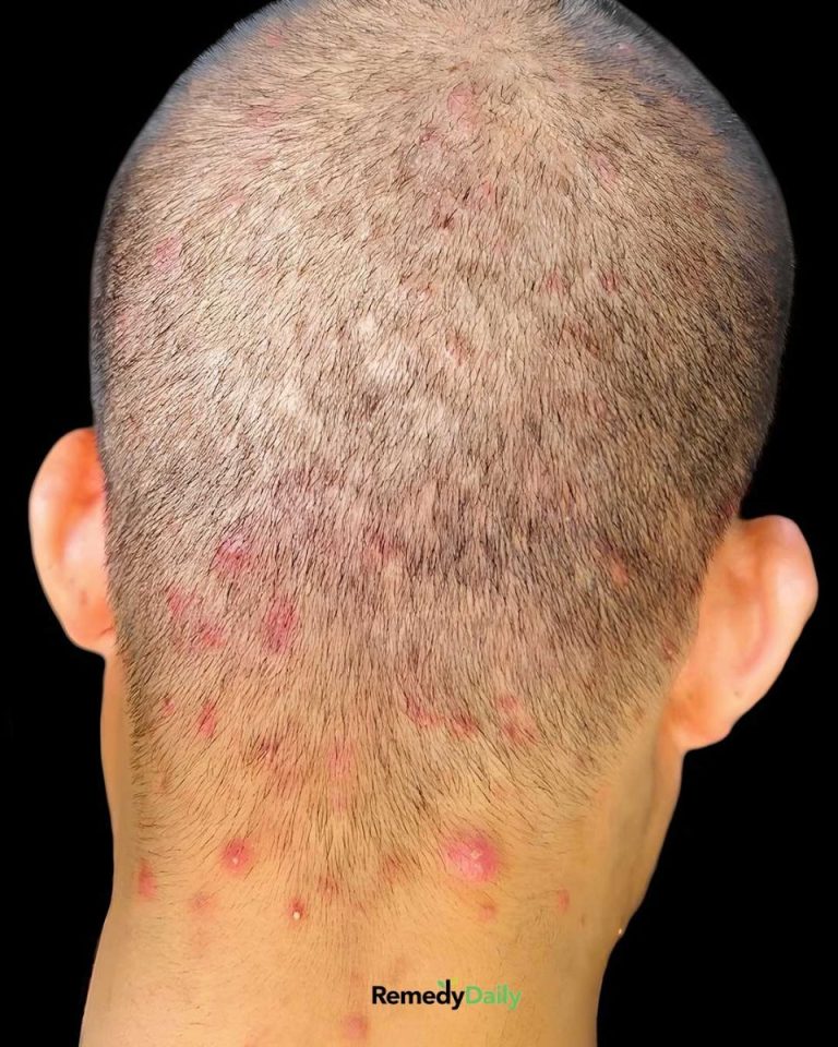 Próbowaliśmy zmieniać szampon, ale skóra głowy mojego syna ciągle się wysypuje. Co pomaga na wysypkę?