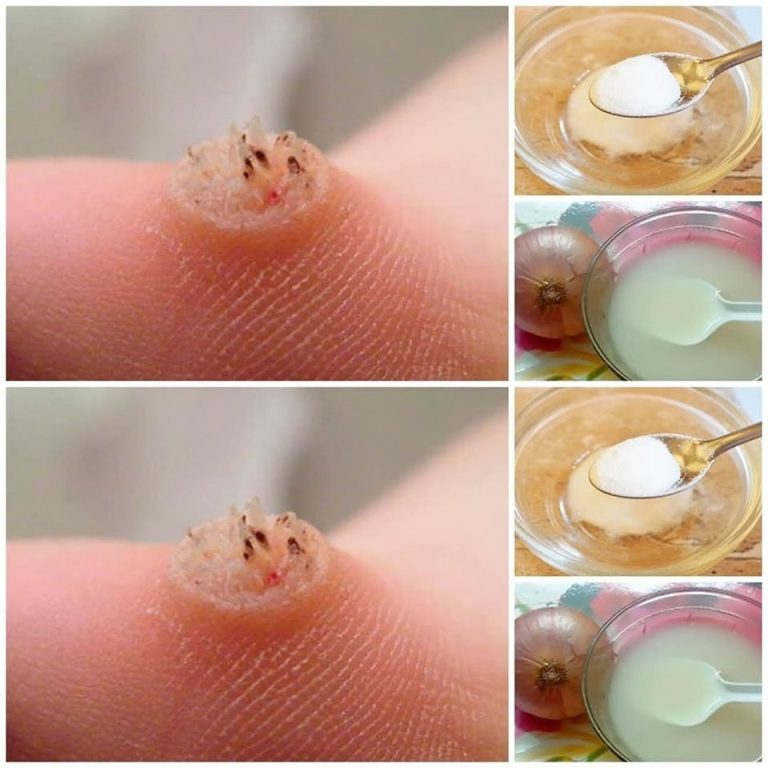 Jak usunąć naturalnie występujące brodawki