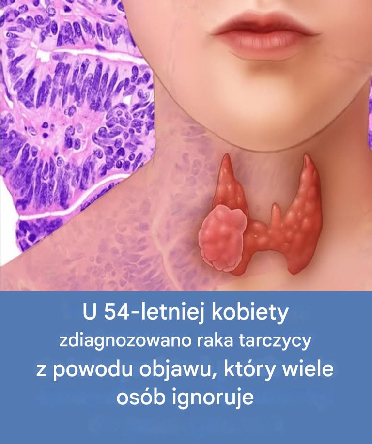 U 54-letniej kobiety stwierdzono raka tarczycy, co często pozostaje niezauważone