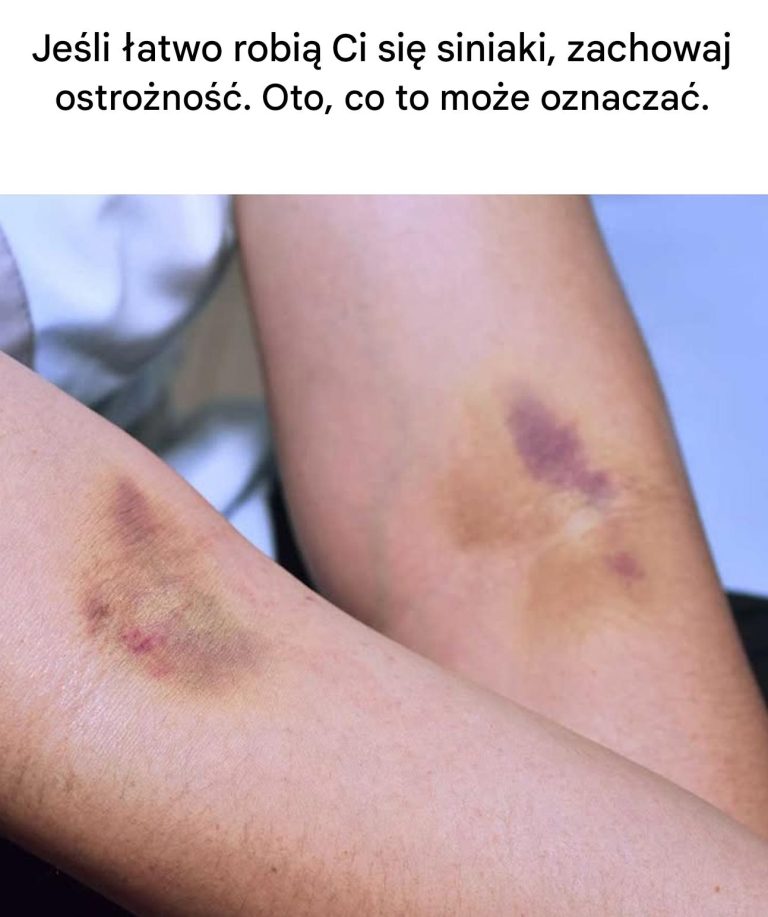 Jeśli często pojawiają Ci się siniaki, oto co one oznaczają