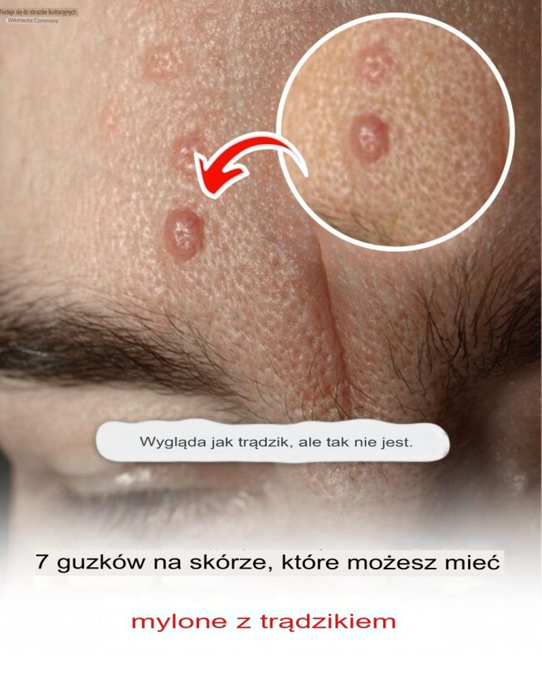 7 guzków skórnych, które możesz pomylić z trądzikiem