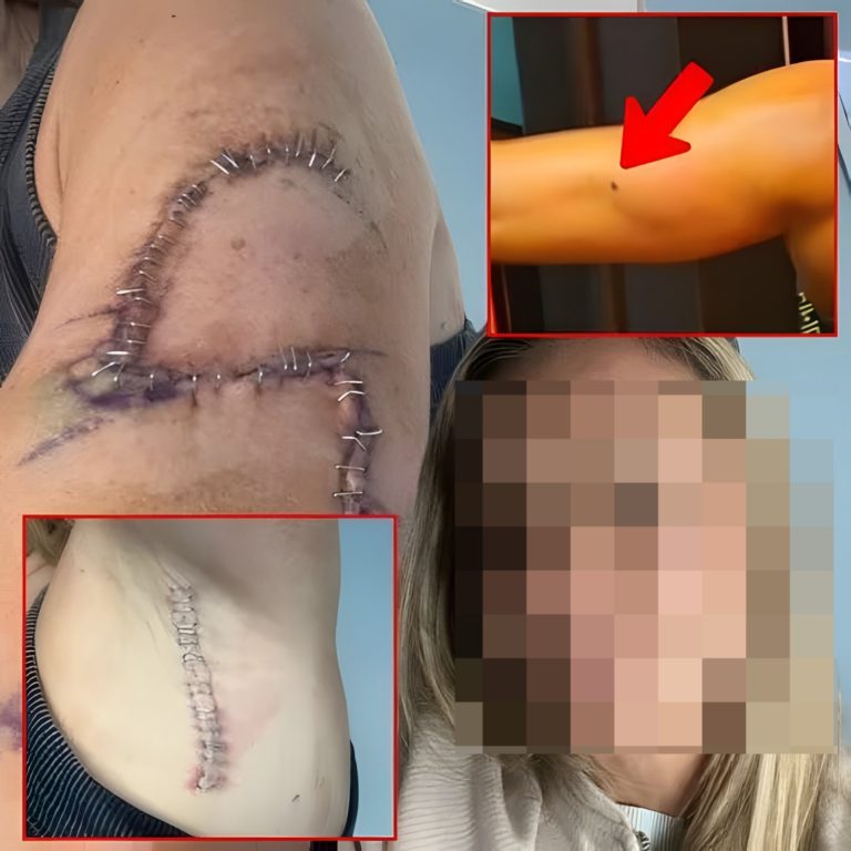Matka ma 77 szwów na ramieniu po zignorowaniu „normalnego” znamienia