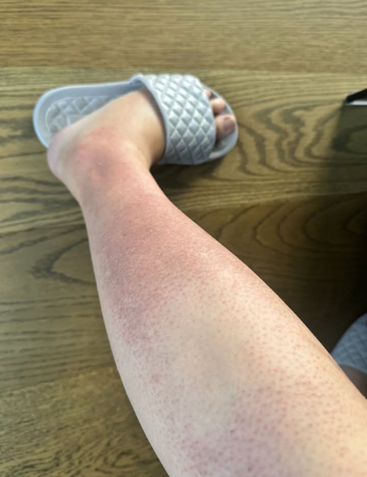 Jestem w 18. tygodniu ciąży i mam okropną wysypkę na nogach. Swędzi i jest grudkowata. Nie mogę się w najbliższym czasie umówić na wizytę u położnej. Co mogę zrobić, żeby ją złagodzić?