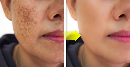 Maseczka z cytryny i pietruszki na niedoskonałości twarzy