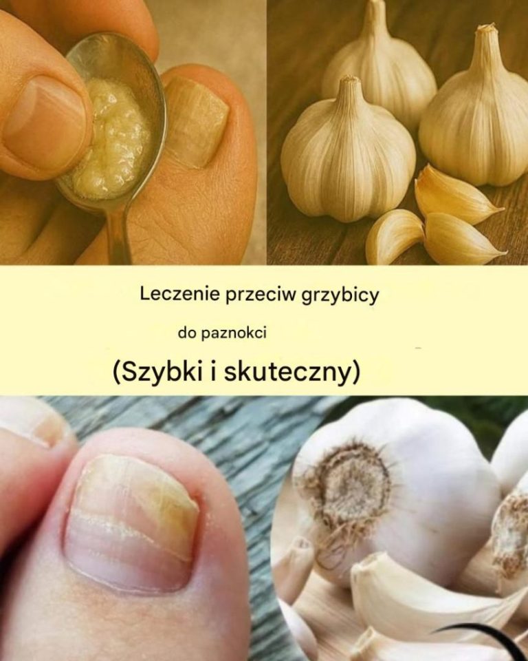 Jak można wykorzystać czosnek do walki z grzybicą paznokci