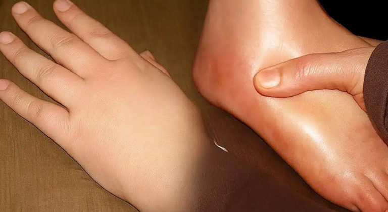 Jak szybko pozbyć się opuchniętych dłoni i stóp: domowe sposoby na zatrzymanie płynów