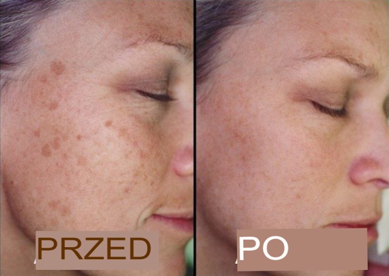 Jak usunąć ciemne plamy na twarzy – ostateczny przewodnik