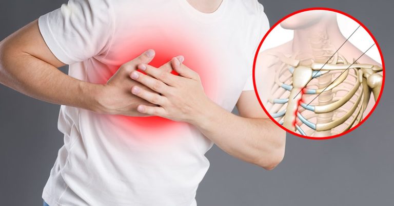 Zapalenie chrząstek żebrowych: czym jest i jak leczyć schorzenie powodujące ból pleców