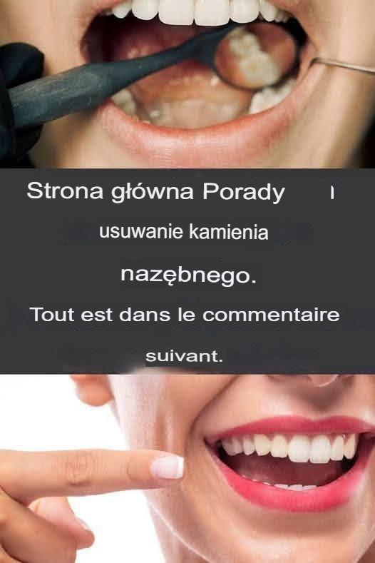 Strona główna Porada dotycząca usuwania kamienia nazębnego