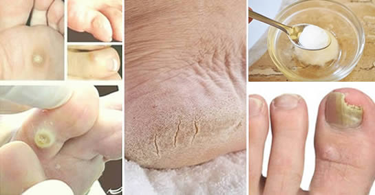 Jak szybko i trwale pozbyć się odcisków, modzeli i grzybicy stóp