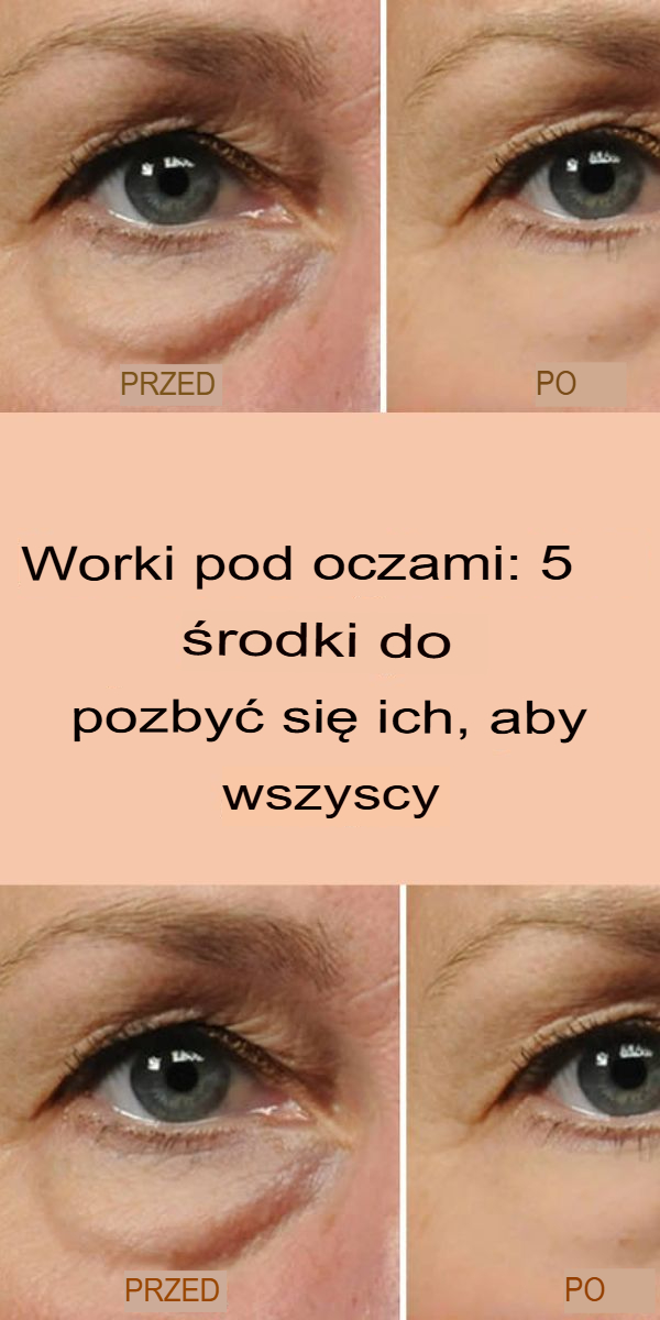 Worki pod oczami: 5 sposobów, aby pozbyć się ich na zawsze