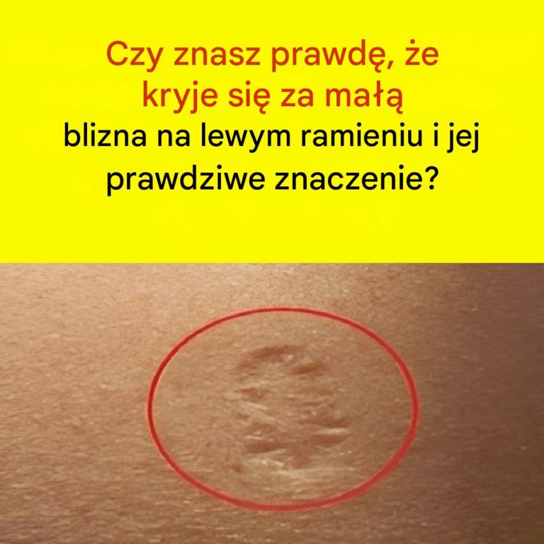 Blizny po szczepionce przeciwko ospie: Jak wyglądają i dlaczego się pojawiają?