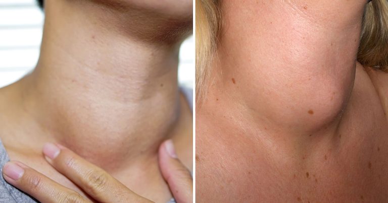 Różnica między hipoterynerstwem a hiperczynstomą tarczycy: czy zwiększasz lub tracisz na wadze?