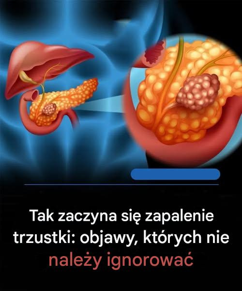 Objawy raka trzustki, które warto znać i jak rozwija się choroba